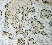 p63 Antibody Esophageal Squamous Cell Carcinoma IHC. Immunohistochemistry testing of p63 antibody and FFPE human esophageal squamous cell carcinoma tissue.