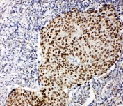 p63 Antibody Lung Cancer IHC. Immunohistochemistry testing of p63 antibody and human lung cancer tissue.