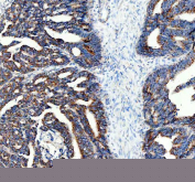 Immunohistochemical staining of FFPE human colon cancer tissue with PMP70 antibody, HRP-secondary and DAB substrate. HIER: boil tissue sections in pH8 EDTA for 20 min and allow to cool before testing.