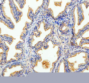 Immunohistochemical staining of FFPE human prostate cancer tissue with PMP70 antibody, HRP-secondary and DAB substrate. HIER: boil tissue sections in pH8 EDTA for 20 min and allow to cool before testing.