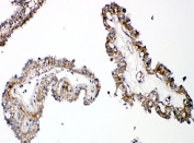 IHC-P: PTH1R antibody testing of human thyroid cancer tissue