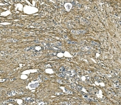 COL1A1 Antibody Human Gastric Carcinoma IHC. IHC staining of FFPE human gastric carcinoma tissue with COL1A1 antibody demonstrated strong extracellular staining throughout the tumor-associated stroma, consistent with the distribution of type I collagen within desmoplastic connective tissue. COL1A1 encodes the alpha-1 chain of type I collagen, a major fibrillar extracellular matrix protein that provides structural support and regulates cell-matrix interactions. The extensive stromal staining observed surrounding malignant glands is consistent with extracellular matrix remodeling and collagen deposition frequently associated with gastric carcinoma progression. Heat-induced epitope retrieval was performed by boiling tissue sections in pH 8 EDTA buffer for 20 minutes and allowing them to cool before immunostaining. These results support the utility of COL1A1 Antibody for studies of extracellular matrix biology, tumor stroma formation, fibrosis, and cancer-associated tissue remodeling.