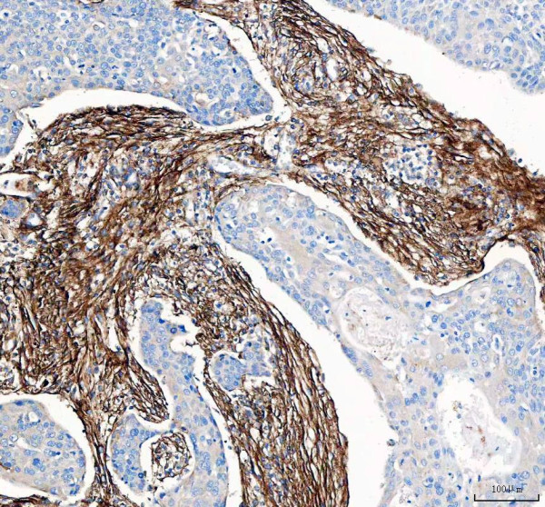 Collagen 1 Antibody / COL1A1 Extracellular Matrix Antibody Human Esophageal Squamous Cell Carcinoma IHC. Immunohistochemical staining of FFPE human esophageal squamous cell carcinoma tissue using Collagen 1 Antibody / COL1A1 Extracellular Matrix Antibody. Collagen I is detected predominantly within the stromal extracellular matrix surrounding tumor nests, consistent with its role in maintaining tissue architecture and supporting the tumor microenvironment. Heat-induced epitope retrieval was performed in pH 8.0 EDTA buffer prior to staining. Tissue sections were blocked with 10% goat serum and incubated with the primary antibody (2 ug/ml) overnight at 4Â°C, followed by a peroxidase-conjugated goat anti-rabbit IgG secondary antibody. Immunoreactivity was visualized using an HRP Super Vision detection system with DAB as the chromogen.