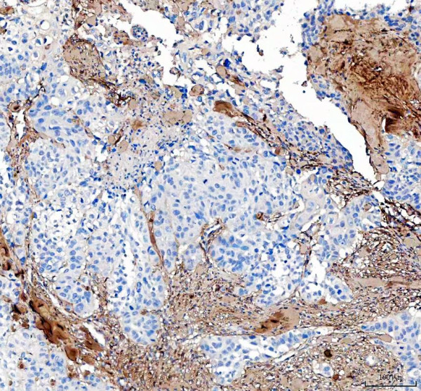 Collagen 1 Antibody / COL1A1 Extracellular Matrix Antibody Human Bladder Cancer IHC. Immunohistochemical staining of FFPE human bladder cancer tissue using Collagen 1 Antibody / COL1A1 Extracellular Matrix Antibody. Collagen I is detected predominantly within the stromal extracellular matrix surrounding tumor nests, consistent with its role in providing structural support and shaping the tumor microenvironment. Heat-induced epitope retrieval was performed in pH 8.0 EDTA buffer prior to staining. Tissue sections were blocked with 10% goat serum and incubated with the primary antibody (2 ug/ml) overnight at 4Â°C, followed by a peroxidase-conjugated goat anti-rabbit IgG secondary antibody. Immunoreactivity was visualized using an HRP Super Vision detection system with DAB as the chromogen.