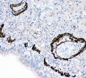 FABP6 Antibody Human Lung Cancer IHC. Immunohistochemical staining of human lung cancer tissue demonstrates FABP6 expression using a FABP6 antibody. FABP6, also known as Bile Acid Binding Protein and Ileal Lipid Binding Protein, is an intracellular transporter involved in bile acid trafficking and lipid metabolism. Predominantly membranous and cytoplasmic staining is observed in malignant epithelial cells, consistent with the metabolic adaptations and altered lipid handling associated with tumor progression. These findings support emerging evidence linking FABP6 expression to cancer metabolism and cellular signaling pathways regulated by bile acids. The results demonstrate the utility of FABP6 Antibody for studies of bile acid transport, metabolic regulation, and tumor biology.