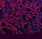 Immunofluorescent staining of FFPE human thyroid cancer tissue with Profilin 2 antibody (red) and DAPI nuclear stain (blue). HIER: steam section in pH8 EDTA buffer for 20 min.