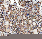 Immunohistochemical staining of FFPE human thyroid cancer tissue with Profilin 2 antibody, HRP-secondary and DAB substrate. HIER: boil tissue sections in pH8 EDTA for 20 min and allow to cool before testing.