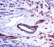 ACE Antibody Prostate Cancer Immunohistochemistry. IHC-P: ACE antibody testing of human prostate cancer tissue.