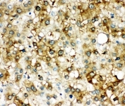 SERPINA3 Antibody Liver Cancer IHC. Immunohistochemistry staining of human liver cancer tissue with SERPINA3 antibody.