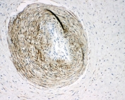Calponin Antibody Placenta IHC. Immunohistochemistry testing of human placental tissue with Calponin antibody. HIER: steam section in pH6 citrate buffer for 20 min and allow to cool prior to testing.