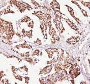 IHC staining of FFPE human ovarian cancer tissue with p53 antibody. HIER: boil tissue sections in pH8 EDTA for 20 min and allow to cool before testing.
