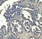p53 Antibody for IP Human Ovarian Cancer IHC. Immunohistochemistry staining of FFPE human ovarian cancer tissue was performed with p53 Antibody for IP, also called Tumor Protein p53 Immunoprecipitation Antibody. Heat-induced epitope retrieval was performed in EDTA buffer, pH 8.0. The antibody was used at 2 ug/ml overnight at 4oC, followed by an HRP-conjugated secondary antibody and DAB detection. Positive nuclear staining is observed in populations of tumor epithelial cells. This p53 Antibody demonstrates detection of endogenous TP53 in human ovarian cancer and complements its validated use for immunoprecipitation.