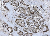 BRCA1 Antibody Colorectal Adenocarcinoma IHC. Immunohistochemistry staining of FFPE human colorectal adenocarcinoma tissue with BRCA1 antibody. HIER: boil tissue sections in pH8 EDTA for 20 min and allow to cool before testing.