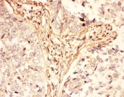 IHC-P: LIF antibody testing of human lung cancer tissue