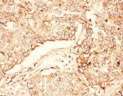 IHC-P: AKT2 antibody testing of human lung cancer tissue
