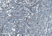 CD34 Antibody Ovarian Cancer IHC. Immunohistochemistry analysis of CD34 expression in FFPE human ovarian cancer shows membranous HRP-DAB brown staining in tumor-associated vascular endothelial cells, highlighting branching microvascular networks and stromal vessel structures within the tumor, while ovarian tumor cells remain largely negative. The staining pattern supports visualization of tumor angiogenesis and endothelial cell distribution in ovarian cancer tissue. HIER: boil tissue sections in pH8 EDTA for 20 min and allow to cool before testing.