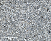 CD34 Antibody Lymphoma IHC. Immunohistochemistry analysis of CD34 expression in FFPE human lymphoma demonstrates membranous HRP-DAB brown staining in vascular endothelial cells within the tumor microenvironment, highlighting dispersed and irregular microvascular structures among lymphoid tumor cells, while lymphoma cells remain largely negative. The staining pattern supports visualization of tumor-associated vasculature and microvascular distribution in lymphoma tissue. HIER: boil tissue sections in pH8 EDTA for 20 min and allow to cool before testing.