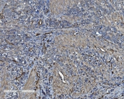 CD34 Antibody Gastric Cancer IHC. Immunohistochemistry analysis of CD34 expression in FFPE human gastric cancer demonstrates membranous HRP-DAB brown staining in tumor-associated vascular endothelial cells, highlighting irregular microvascular networks and stromal vessel structures within the tumor, while gastric epithelial tumor cells remain largely negative. The staining pattern emphasizes angiogenic remodeling and endothelial cell distribution characteristic of gastric cancer. HIER: boil tissue sections in pH8 EDTA for 20 min and allow to cool before testing.