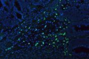 Myeloperoxidase (MPO) Antibody Endometrial Cancer IF. Immunofluorescent staining of FFPE human endometrial cancer tissue using MPO Antibody demonstrates distinct green fluorescence within scattered infiltrating myeloid cells distributed throughout the tumor-associated stromal compartment. The staining pattern is consistent with expression of Myeloperoxidase (MPO), a heme-containing peroxidase enzyme abundantly expressed in neutrophils, granulocytes, and other myeloid lineage cells involved in innate immune responses. MPO-positive cells are readily distinguished from the surrounding tumor tissue, highlighting inflammatory cell infiltration within the endometrial carcinoma microenvironment. Nuclei are counterstained with DAPI (blue). Heat-mediated antigen retrieval was performed in pH 8.0 EDTA buffer prior to overnight primary antibody incubation and fluorescent secondary antibody detection.