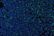 Myeloperoxidase (MPO) Antibody Stomach Cancer IF. Immunofluorescent staining of FFPE human stomach cancer tissue using MPO Antibody demonstrates distinct green fluorescence within scattered infiltrating inflammatory cells distributed throughout the tumor microenvironment. The staining pattern is consistent with expression of Myeloperoxidase (MPO), a heme-containing lysosomal peroxidase highly expressed in neutrophils, granulocytes, and other myeloid lineage cells involved in innate immune defense. MPO-positive cells are readily identifiable against a background of predominantly negative gastric carcinoma cells, highlighting tumor-associated myeloid infiltrates within the neoplastic tissue. The observed staining is consistent with the established use of MPO as a marker of granulocytic differentiation and inflammatory cell identification in cancer tissues. Nuclei are counterstained with DAPI (blue). Heat-mediated antigen retrieval was performed in pH 8.0 EDTA buffer prior to overnight primary antibody incubation and fluorescent secondary antibody detection.
