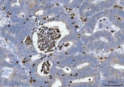 Myeloperoxidase (MPO) Antibody Endometrial Adenocarcinoma IHC. Immunohistochemistry staining of FFPE human endometrial adenocarcinoma tissue using MPO Antibody demonstrates strong granular cytoplasmic HRP-DAB brown staining in infiltrating myeloid cells located within glandular lumina and throughout the tumor-associated stromal compartment. The staining pattern is consistent with expression of Myeloperoxidase (MPO), a heme-containing peroxidase abundantly expressed in neutrophils, granulocytes, and other cells of myeloid lineage. MPO-positive inflammatory cells are readily distinguished from the surrounding neoplastic epithelial cells, highlighting the presence of tumor-associated myeloid infiltrates within the endometrial carcinoma microenvironment. The observed staining is consistent with the established use of MPO as a marker of granulocytic differentiation and myeloid cell identification in both normal and neoplastic tissues. HIER: boil tissue sections in pH 8 EDTA buffer for 20 minutes and allow to cool before testing.