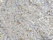 Myeloperoxidase (MPO) Antibody Lung Adenocarcinoma IHC. Immunohistochemistry staining of FFPE human lung adenocarcinoma tissue using MPO Antibody demonstrates scattered granular cytoplasmic HRP-DAB brown staining in infiltrating myeloid cells distributed throughout the tumor parenchyma and stromal compartments. The staining pattern is consistent with expression of Myeloperoxidase (MPO), a heme-containing lysosomal enzyme characteristically expressed in neutrophils, granulocytic precursors, and other cells of myeloid lineage. MPO-positive inflammatory cells are readily identified against a background of predominantly negative neoplastic epithelial cells, highlighting the presence of tumor-associated myeloid infiltrates within the lung adenocarcinoma microenvironment. The observed staining is consistent with the established use of MPO as a marker of granulocytic differentiation and innate immune cell infiltration in normal and malignant tissues. HIER: boil tissue sections in pH 8 EDTA buffer for 20 minutes and allow to cool before testing.