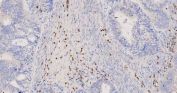 Myeloperoxidase (MPO) Antibody Endometrial Cancer IHC. Immunohistochemistry staining of FFPE human endometrial cancer tissue using MPO Antibody demonstrates scattered granular cytoplasmic HRP-DAB brown staining within infiltrating inflammatory cells located throughout the tumor-associated stromal compartment. The staining pattern is consistent with expression of Myeloperoxidase (MPO), a heme-containing peroxidase enzyme abundantly expressed in neutrophils, granulocytes, and other myeloid lineage cells involved in innate immune responses. MPO-positive inflammatory cells are readily distinguished from the surrounding neoplastic epithelial elements, highlighting the presence of tumor-associated myeloid infiltrates within the endometrial carcinoma microenvironment. The observed staining is consistent with the established use of MPO as a marker of granulocytic differentiation and myeloid cell identification in both normal and malignant tissues. HIER: heat-mediated antigen retrieval in pH 8.0 EDTA buffer prior to overnight primary antibody incubation and HRP-DAB chromogenic detection.