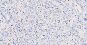 Myeloperoxidase (MPO) Antibody Stomach Cancer IHC. Immunohistochemistry staining of FFPE human stomach cancer tissue using MPO Antibody demonstrates scattered granular cytoplasmic HRP-DAB brown staining within infiltrating inflammatory cells distributed throughout the tumor microenvironment. The staining pattern is consistent with expression of Myeloperoxidase (MPO), a heme-containing peroxidase enzyme highly expressed in neutrophils, granulocytes, and other myeloid lineage cells. MPO-positive inflammatory cells are readily identifiable against a background of predominantly negative gastric carcinoma cells, highlighting the presence of tumor-associated myeloid infiltrates within the neoplastic tissue. The observed staining is consistent with the established use of MPO as a marker of granulocytic differentiation, innate immune activity, and myeloid cell identification in both normal and malignant tissues. HIER: heat-mediated antigen retrieval in pH 8.0 EDTA buffer prior to overnight primary antibody incubation and HRP-DAB chromogenic detection.