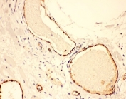 vWF Antibody / Microvessel Density Marker Antibody. Immunohistochemistry analysis of human lung cancer tissue shows HRP-DAB brown staining of endothelial cells forming discrete microvascular profiles within the tumor microenvironment. Numerous small-caliber vessels and capillary-like structures are clearly delineated, allowing visualization of microvessel distribution between tumor cell clusters. The staining pattern supports identification and assessment of microvessel density by highlighting individual endothelial-lined structures across the tissue section. HIER: steam section in pH6 citrate buffer for 20 min and allow to cool prior to testing.