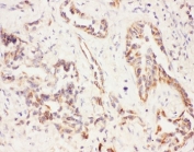 Eotaxin-3 Antibody Human Lung Cancer IHC. IHC staining of FFPE human lung cancer tissue with Eotaxin-3 antibody demonstrated cytoplasmic and membranous staining in malignant epithelial cells and surrounding stromal elements, consistent with the expression pattern of Eotaxin-3 (CCL26), a CC chemokine involved in eosinophil recruitment and Th2-mediated inflammatory responses. Eotaxin-3 participates in immune signaling through CCR3 and contributes to the inflammatory tumor microenvironment. The staining pattern observed is consistent with the known expression of CCL26 in epithelial tissues and its role in regulating interactions between tumor cells and infiltrating immune cells. Immunostaining supports the utility of Eotaxin-3 Antibody for studies of chemokine biology, allergic inflammation, eosinophil trafficking, and tumor-associated immune responses.