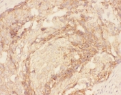 Eotaxin-3 Antibody Human Breast Cancer IHC. IHC staining of FFPE human breast cancer tissue with Eotaxin-3 antibody demonstrated cytoplasmic and membranous staining in malignant epithelial cells and surrounding stromal components, consistent with the expression pattern of Eotaxin-3 (CCL26), a CC chemokine that regulates eosinophil recruitment and Th2-associated immune responses. Eotaxin-3 participates in inflammatory signaling through CCR3 and contributes to communication between tumor cells and the immune microenvironment. The staining observed in both neoplastic and stromal compartments is consistent with reported expression of CCL26 in epithelial tumors and inflammatory tissues. These results support the utility of Eotaxin-3 Antibody for studies of chemokine biology, allergic inflammation, eosinophil trafficking, and tumor-associated immune responses.