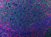 CD3 epsilon Antibody for IF. Immunofluorescence analysis of CD3 Epsilon / CD3E antibody in FFPE human tonsil tissue using a rabbit polyclonal CD3e Immunofluorescence Antibody. CD3-positive T lymphocytes are detected as bright pink membrane-associated and cytoplasmic fluorescence predominantly within interfollicular and paracortical regions, while CD20 monoclonal antibody (green) labels B cells within follicular structures. DAPI (blue) marks cell nuclei, providing clear architectural context. The staining highlights the spatial segregation of T-cell and B-cell compartments within tonsillar lymphoid tissue. Heat-induced epitope retrieval was performed by steaming tissue sections in pH 8 EDTA buffer for 20 minutes prior to staining.