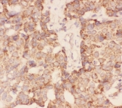 IFSH beta Antibody Breast Cancer Immunohistochemistry. HC-P: FSH beta antibody testing of human breast cancer tissue.