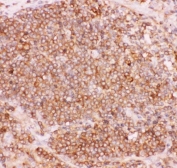 NFKB2 Antibody Lung Cancer IHC. Immunohistochemistry staining of FFPE human lung cancer tissue with NFKB2 antibody. HIER: boil tissue sections in pH8 EDTA for 20 min and allow to cool before testing.