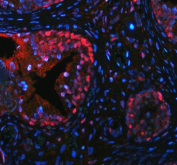 p63 Antibody for IF. Immunofluorescence analysis of FFPE human prostate hyperplasia tissue using a rabbit polyclonal p63 antibody for IF demonstrates strong nuclear staining in basal epithelial cells (red), consistent with the role of Tumor protein 63 (TP63) as a nuclear transcription factor. Signal is restricted to the basal cell layer surrounding glandular structures, while luminal epithelial cells remain largely negative, clearly outlining epithelial architecture and basal cell compartments. DAPI nuclear counterstain (blue) labels all nuclei, providing contrast for precise identification of TP63-positive cells within the tissue. Heat-induced epitope retrieval was performed by steaming sections in pH 8 EDTA buffer for 20 minutes prior to antibody incubation.