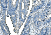 IHC staining of FFPE human adenocarcinoma of the rectum with BRAF antibody. HIER: boil tissue sections in pH8 EDTA for 20 min and allow to cool before testing.