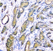 Prostate Specific Antigen Rabbit Polyclonal IHC staining of human prostate cancer. Immunohistochemistry analysis of FFPE human prostate carcinoma using Prostate Specific Antigen Rabbit Polyclonal demonstrates HRP-DAB brown cytoplasmic staining in malignant glandular epithelial cells forming irregular tumor glands, consistent with Prostate specific antigen (KLK3) expression in prostate-derived tumor epithelium. Surrounding stromal cells are largely negative. HIER: tissue sections were boiled in pH 8 EDTA buffer for 20 minutes and allowed to cool before testing.