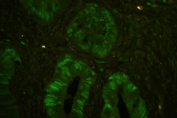 MCM7 Antibody for IF - immunofluorescence staining of human colon cancer tissue. FFPE human colon carcinoma tissue was stained with MCM7 Antibody for IF using a rabbit polyclonal antibody targeting Minichromosome maintenance complex component 7 / MCM7. Green nuclear fluorescence is observed in many tumor epithelial cells lining the glandular structures, consistent with the nuclear localization of this DNA replication licensing factor in proliferating cells. The staining highlights clusters of actively cycling carcinoma cells within the tumor epithelium. Heat-induced epitope retrieval was performed by steaming tissue sections in pH6 citrate buffer for 20 minutes prior to staining.