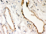 Dystrophin Antibody Lung Cancer Immunohistochemistry. IHC-P: Dystrophin antibody testing of human lung cancer tissue.