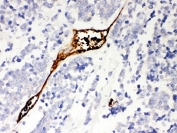 IHC of Mesothelin antibody in human lung cancer tissue. The rabbit polyclonal antibody demonstrates focal HRP-DAB brown staining localized to tumor-associated epithelial cells, with predominantly membranous and cytoplasmic signal consistent with Mesothelin expression in carcinoma cells. Surrounding stromal and inflammatory cells show minimal background staining. Heat-induced epitope retrieval was performed by steaming sections in pH 6 citrate buffer prior to antibody incubation.