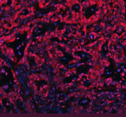 Immunofluorescent staining of FFPE human pancreas cancer tissue with c-Myb antibody (red) and DAPI nuclear stain (blue). HIER: steam section in pH8 EDTA buffer for 20 min.