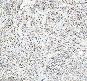 IHC staining of FFPE human breast cancer tissue with NEDD9 antibody. HIER: boil tissue sections in pH8 EDTA for 20 min and allow to cool before testing.