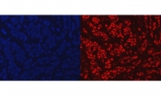 PARP1 Antibody Breast Cancer IF. Immunofluorescence analysis of FFPE human breast cancer tissue using PARP1 antibody. PARP1 staining (red) demonstrates widespread nuclear localization within tumor cell populations, consistent with the chromatin-associated activity of this repair protein in DNA strand break signaling and genomic stability maintenance pathways. Nuclei are counterstained blue with DAPI. Heat-induced epitope retrieval was performed by steaming tissue sections in pH8 EDTA buffer for 20 minutes prior to staining.