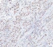 PARP1 Antibody Bladder Tissue IHC. Immunohistochemistry analysis of FFPE human bladder tissue using PARP1 antibody. Urothelial and stromal cell nuclei demonstrate HRP-DAB brown staining consistent with the chromatin-associated localization of PARP1 in DNA repair, genomic surveillance, and nuclear stress-response signaling pathways. Nuclei are counterstained blue. Heat-induced epitope retrieval was performed by boiling tissue sections in pH8 EDTA buffer for 20 minutes followed by cooling prior to staining.