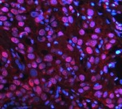 PARP1 Antibody Bladder Cancer IF. Immunofluorescence analysis of FFPE human bladder cancer tissue using PARP1 antibody. PARP1 staining (red) demonstrates strong nuclear localization within tumor cell populations, consistent with the chromatin-associated role of this repair protein in genomic stability maintenance and nuclear stress-response signaling pathways in proliferative carcinoma tissue. Nuclei are counterstained blue with DAPI. Heat-induced epitope retrieval was performed by steaming tissue sections in pH8 EDTA buffer for 20 minutes prior to staining.