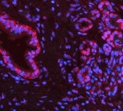 PARP1 Antibody Pancreas Cancer IF. Immunofluorescence analysis of FFPE human pancreas cancer tissue using PARP1 antibody. PARP1 staining (red) demonstrates strong nuclear localization within pancreatic tumor epithelial cells, consistent with the chromatin-associated role of this repair protein in genomic maintenance and nuclear stress-response signaling pathways active in proliferative carcinoma tissue. Nuclei are counterstained blue with DAPI. Heat-induced epitope retrieval was performed by steaming tissue sections in pH8 EDTA buffer for 20 minutes prior to staining.