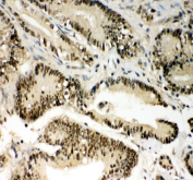 IHC staining of FFPE human colon cancer tissue with PIN1 antibody, HRP-secondary and DAB substrate. HIER: boil tissue sections in pH8 EDTA for 20 min and allow to cool before testing.