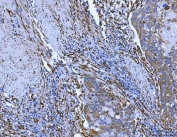 HSP47 Antibody Human Esophageal Squamous Carcinoma IHC. HSP47 Antibody was used for immunohistochemical staining of FFPE human esophageal squamous carcinoma tissue following heat-induced epitope retrieval in pH 8 EDTA buffer. The tissue was incubated with the primary antibody, followed by an HRP-conjugated secondary antibody and DAB chromogen for visualization. Strong cytoplasmic staining is observed in malignant squamous epithelial cells with additional labeling of stromal fibroblast-like cells, consistent with the endoplasmic reticulum localization and collagen chaperone function of SERPINH1. This HSP47 Antibody, a Collagen Chaperone Antibody, is well suited for studying collagen biosynthesis, extracellular matrix remodeling, fibrosis, and stromal responses in esophageal squamous carcinoma.