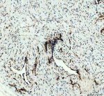 HSP47 Antibody Breast Cancer IHC. HSP47 Antibody was used for immunohistochemical staining of FFPE human breast cancer tissue following heat-induced epitope retrieval in pH 8 EDTA buffer. The section was incubated with the primary antibody at 2 ug/ml, followed by an HRP-conjugated goat anti-rabbit secondary antibody and DAB chromogen for visualization. Distinct cytoplasmic staining is observed within tumor-associated stromal cells and collagen-producing regions, consistent with the endoplasmic reticulum localization and collagen chaperone function of SERPINH1. This HSP47 Antibody, a Collagen Chaperone Antibody, is well suited for investigating extracellular matrix remodeling, collagen biosynthesis, fibrosis, and the stromal response associated with breast cancer.