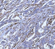 HSP47 Antibody Human Breast Cancer Tissue IHC. HSP47 Antibody was used for immunohistochemical staining of FFPE human breast cancer tissue following heat-induced epitope retrieval in pH 8 EDTA buffer. The tissue was incubated with the primary antibody, followed by an HRP-conjugated secondary antibody and DAB chromogen for visualization. Strong cytoplasmic staining is observed in malignant epithelial cells with additional labeling of stromal spindle-shaped cells, consistent with the endoplasmic reticulum localization and collagen chaperone function of SERPINH1. This HSP47 Antibody, a Collagen Chaperone Antibody, is well suited for investigating collagen biosynthesis, extracellular matrix remodeling, fibrosis, and the tumor microenvironment in breast cancer.